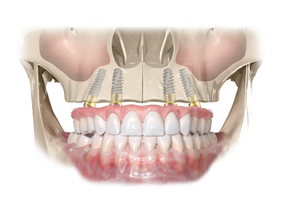 Dental Implants