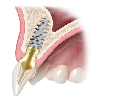 Dental Implants Jaw